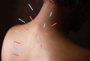 Acupuncture Treatment for Acne