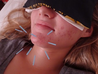 Facial Acupuncture for Cystic Acne