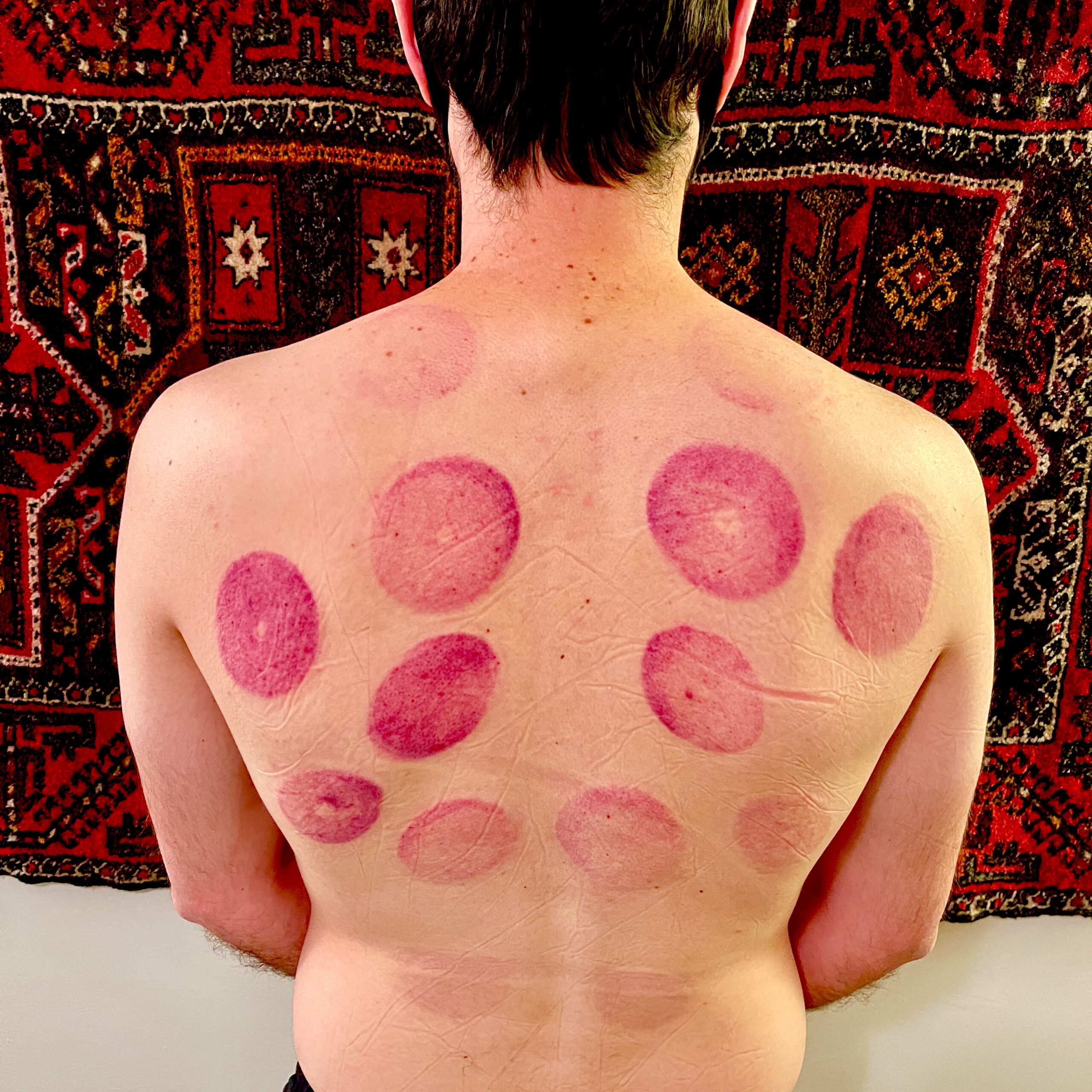 Cupping Marks After Dry Needling